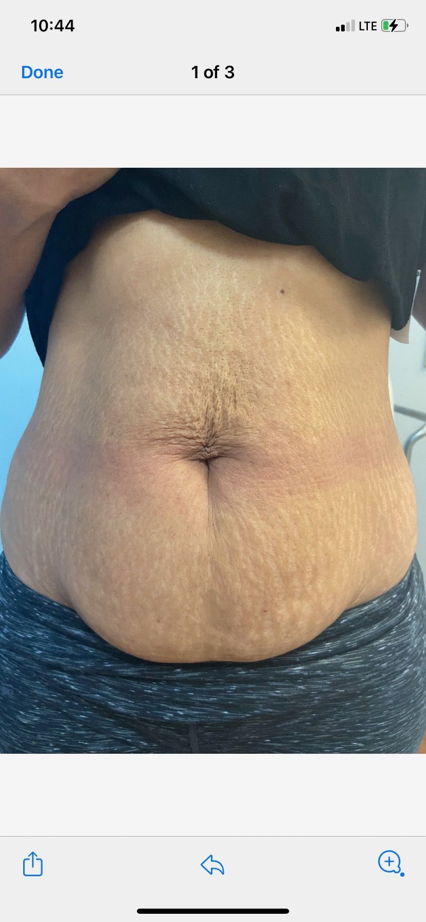 Client's body before treatment by Body Lyft System.