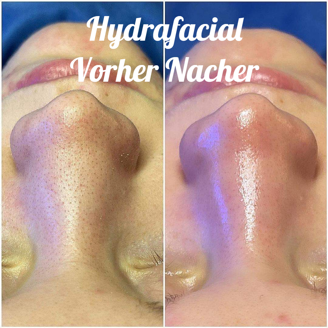 Ein Vorher-Nachher-Foto der Nase einer Person mit der Überschrift Hydrafacial vorher nacher
