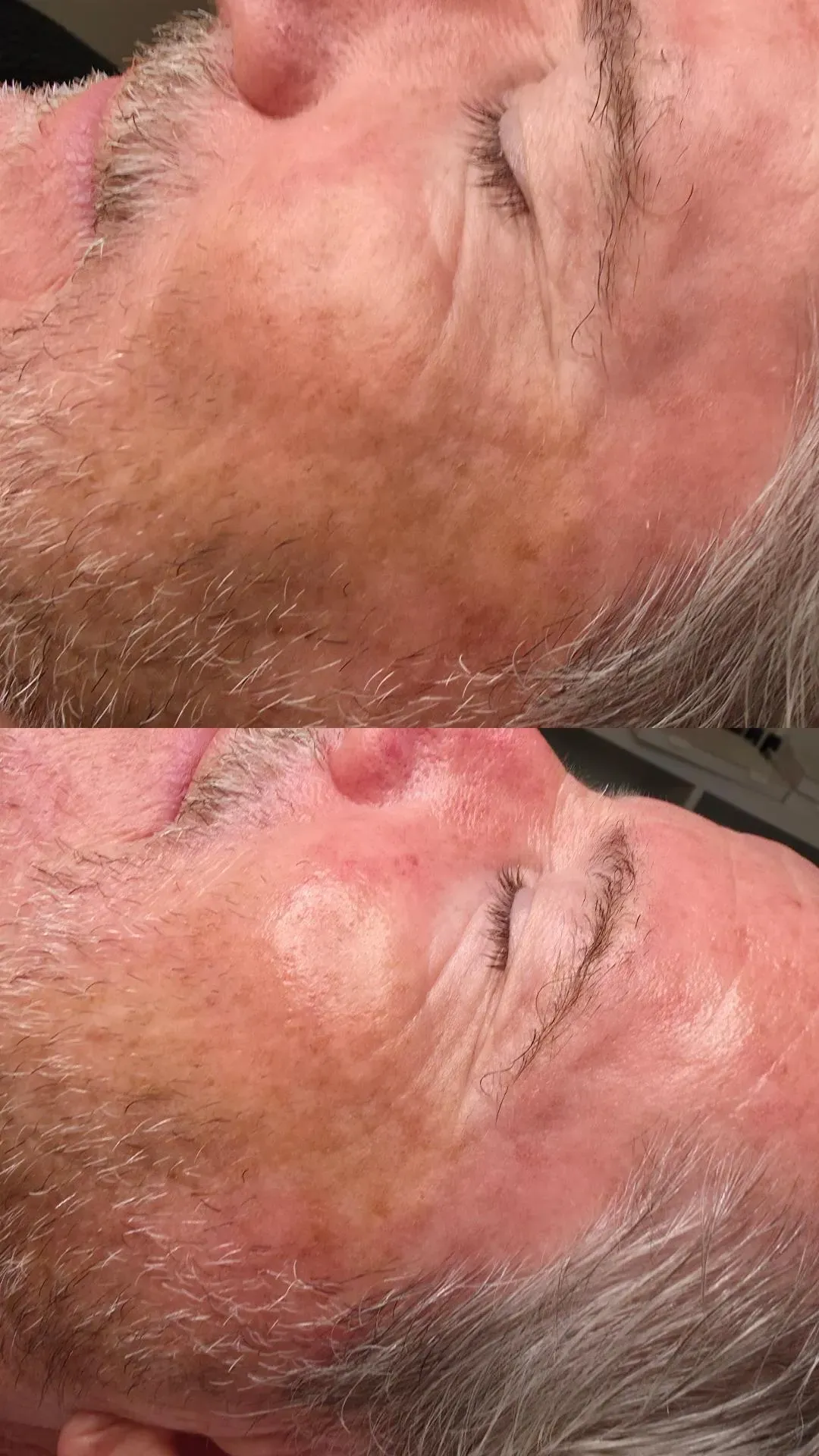 Zwei Nahaufnahmen von Wange und Auge einer Person vor und nach einer Behandlung. Die Haut wirkt in der zweiten Ansicht röter.