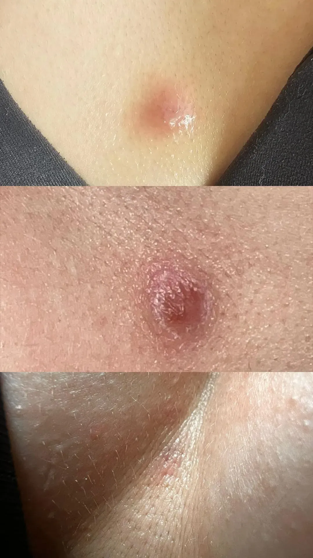 Drei Nahaufnahmen einer Hautläsion; die obere ist rosa und erhaben, die mittlere ist 