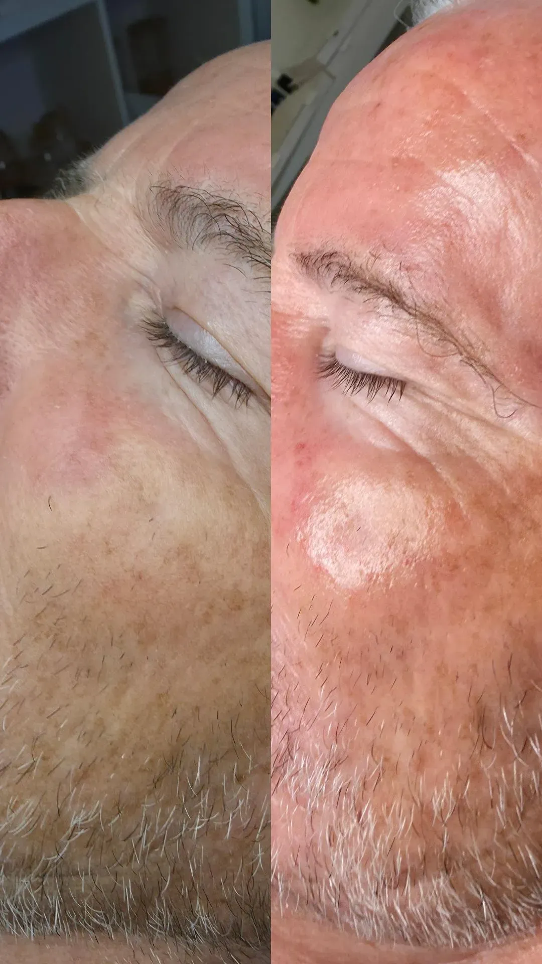 Vergleich des Gesichts eines Mannes vor und nach der Behandlung: Die Haut wirkt strahlender und glatter.