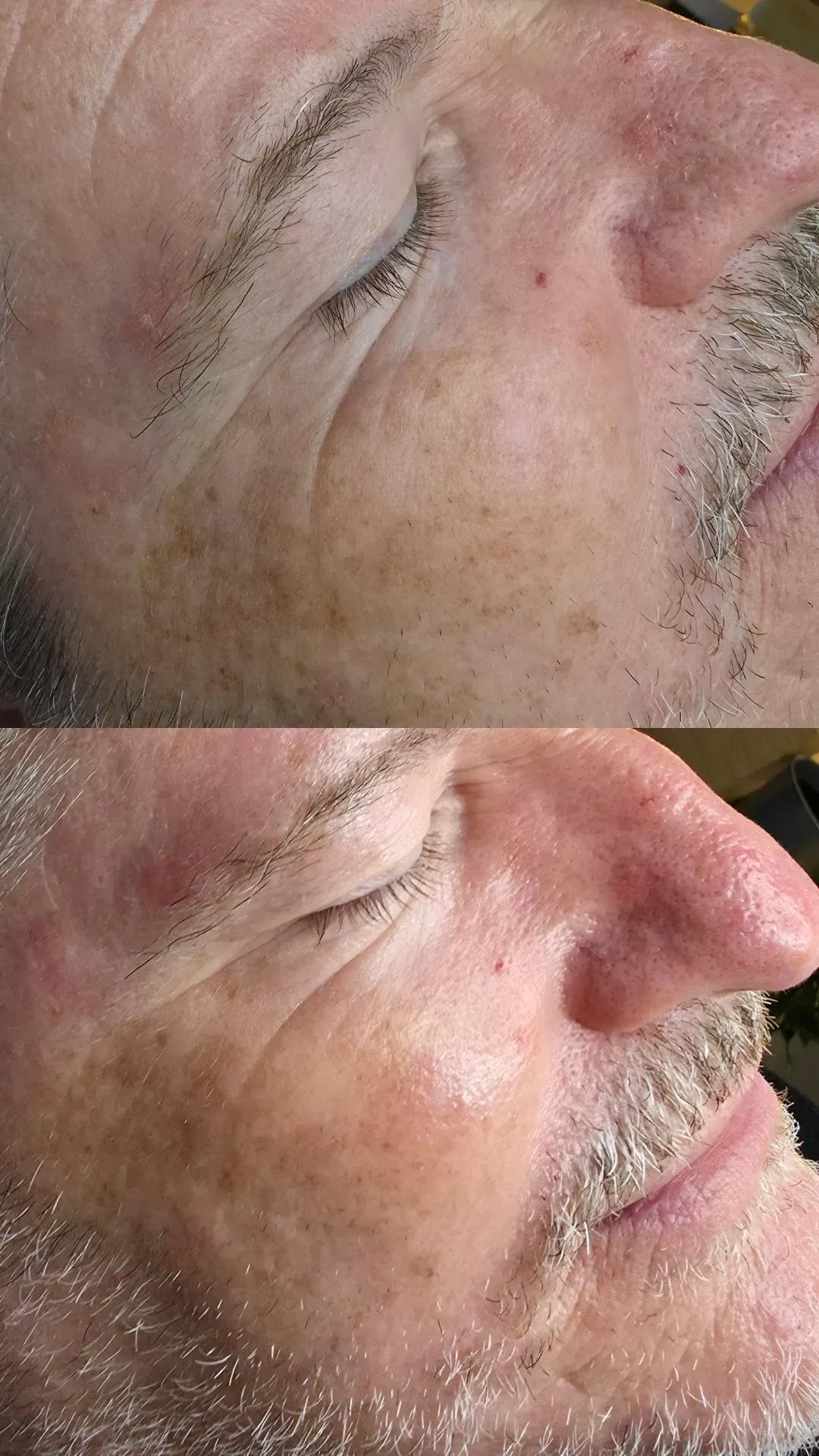 Vergleich: Oben – geschlossenes Auge, faltiges Gesicht; unten 