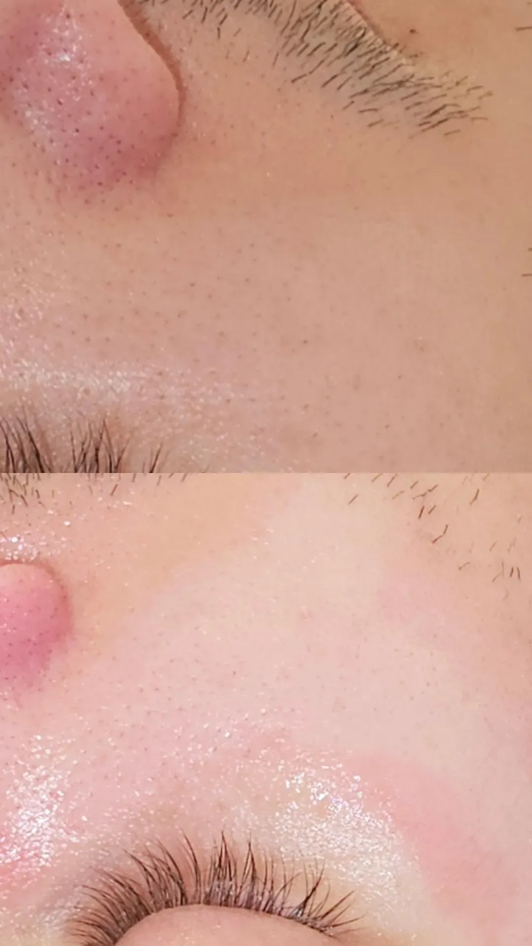 Direkter Vergleich der Haut vor und nach der Behandlung, der eine Reduzierung von Rötungen und Hautunreinheiten zeigt.