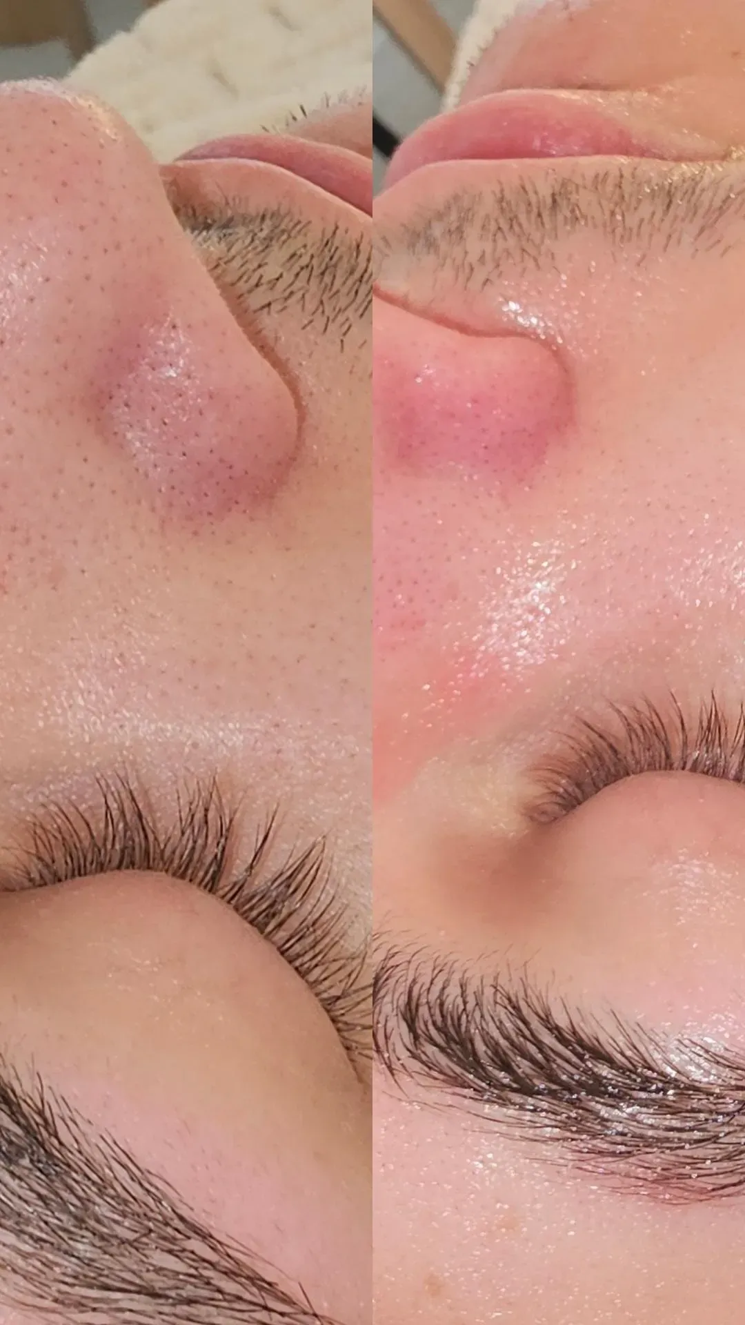 Vergleich der Haut mit sichtbaren Poren vor und nach der Behandlung im Bereich der Nase.