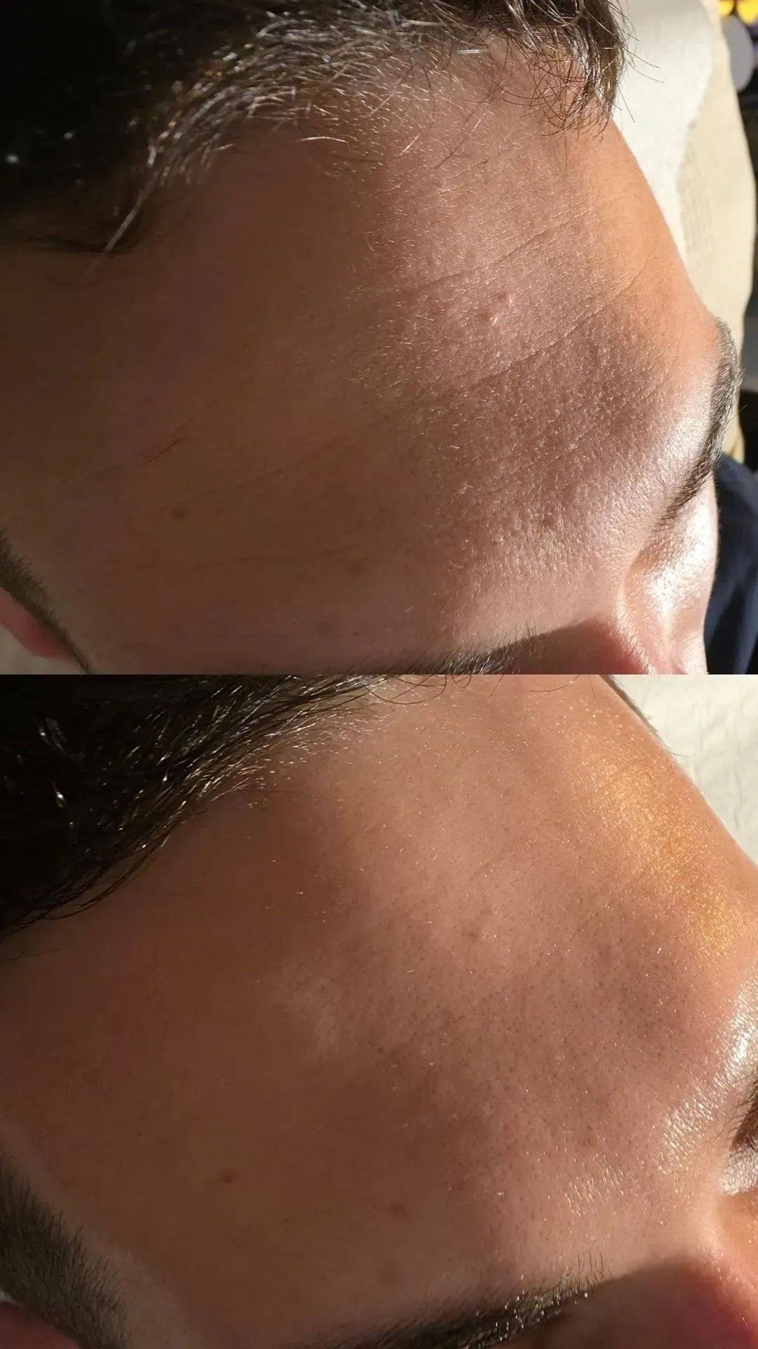 Zwei Nahaufnahmen einer menschlichen Stirn, eine mit strukturierter Oberfläche, die andere glatter.