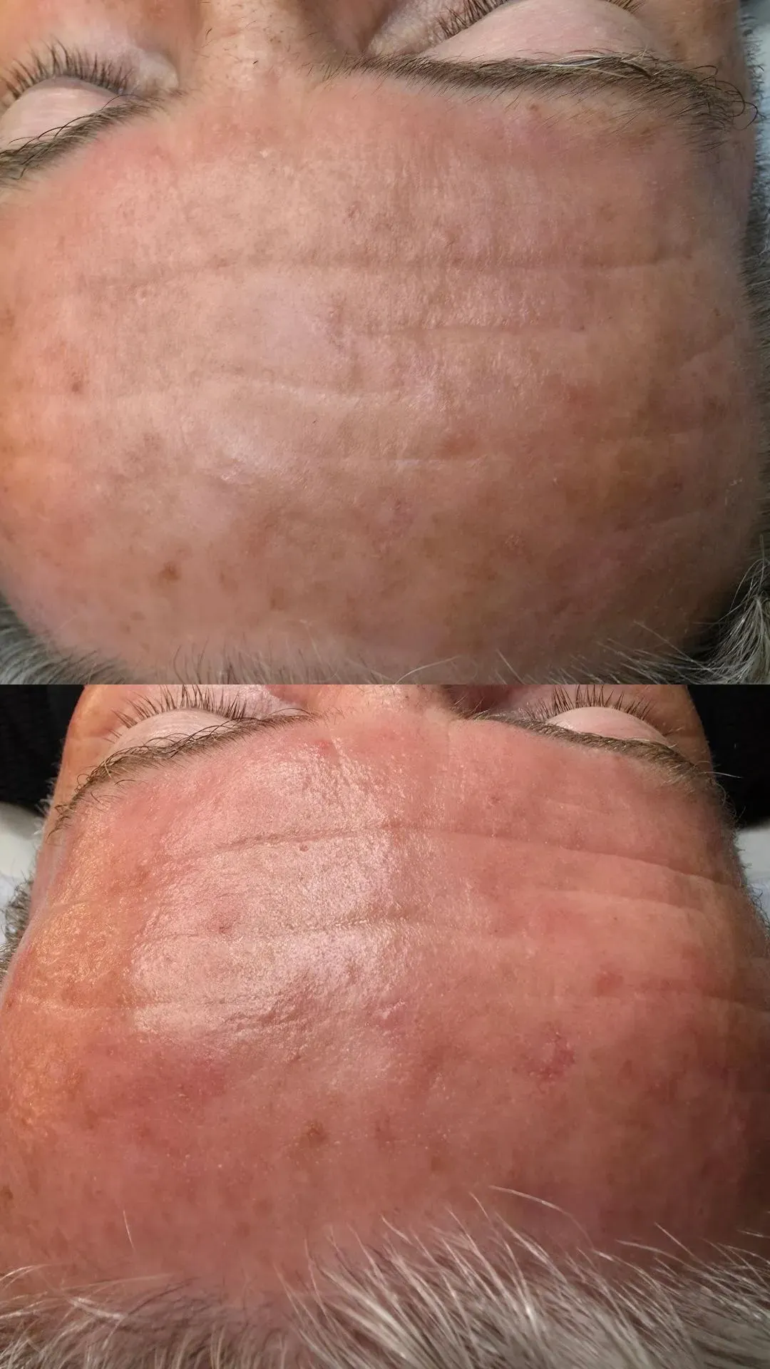 Vorher- und Nachher-Nahaufnahme der Stirn; vorher sind Falten und Flecken zu sehen.