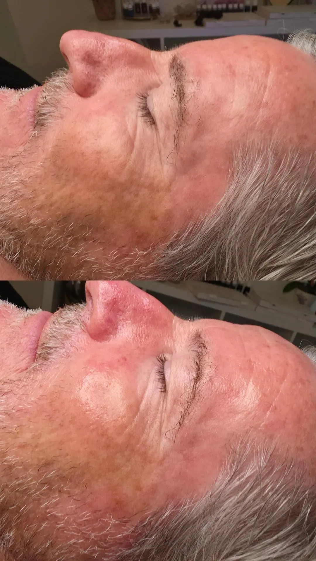 Direkter Vergleich zweier Gesichter. Oberes Bild: Die Haut ist weniger gerötet. Unteres Bild: Die Haut ist stärker gerötet.