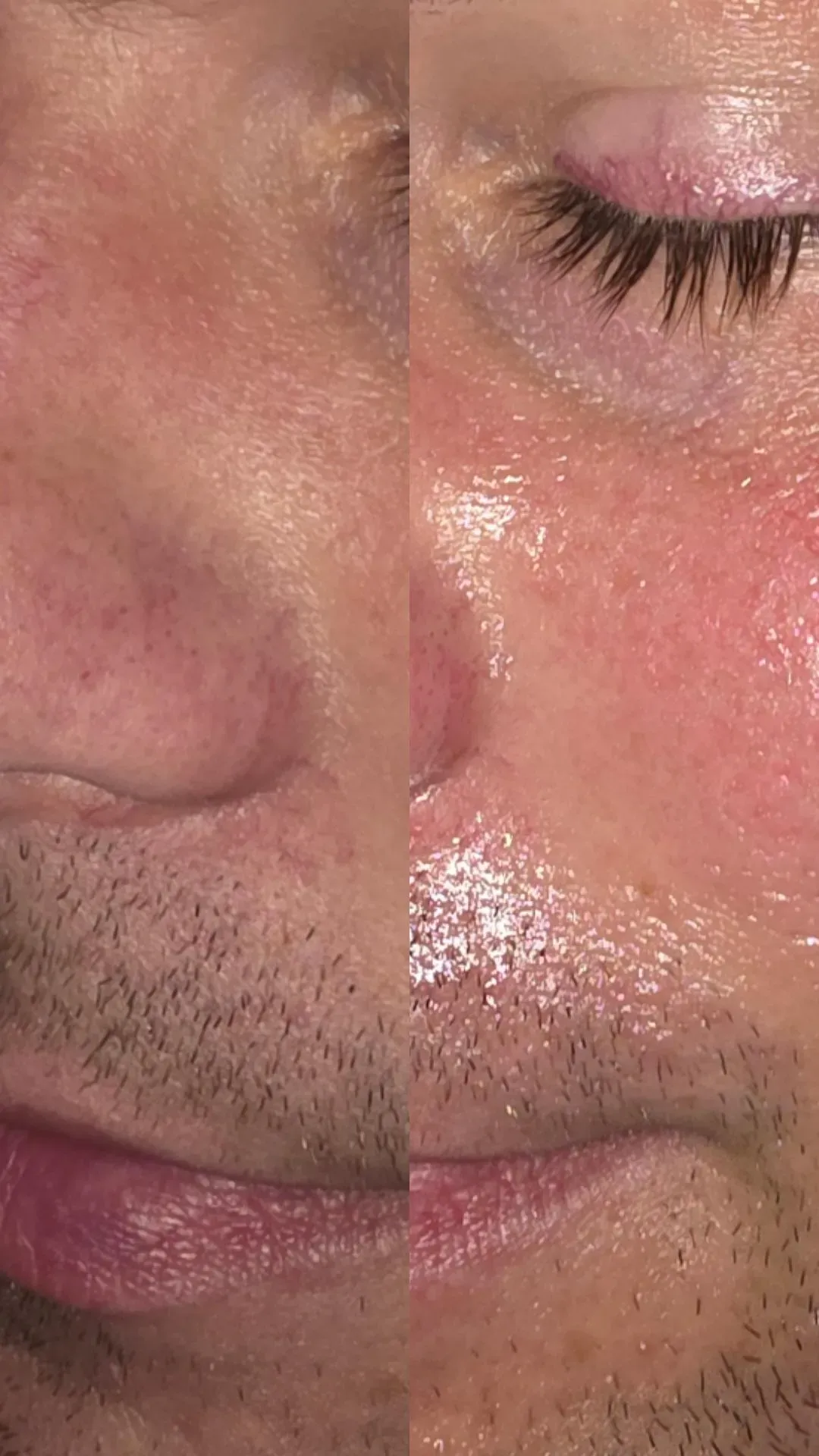 Nahaufnahme eines in zwei Hälften geteilten Gesichts. Eine Hälfte ist trocken, die andere wirkt ölig und rot.