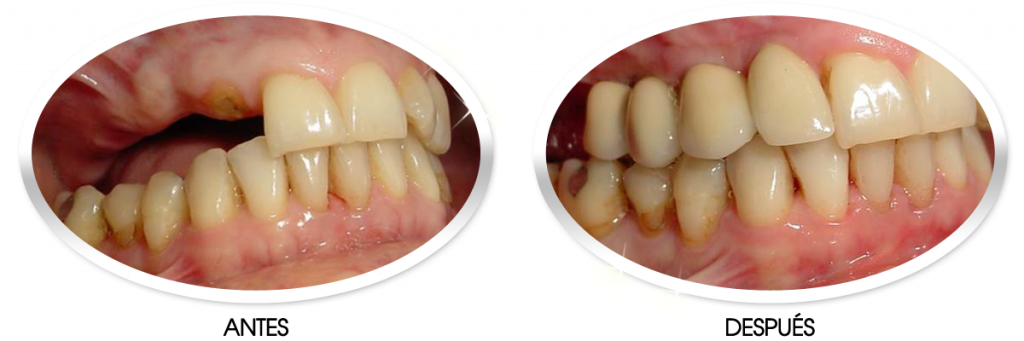 Caso Dientes Posteriores