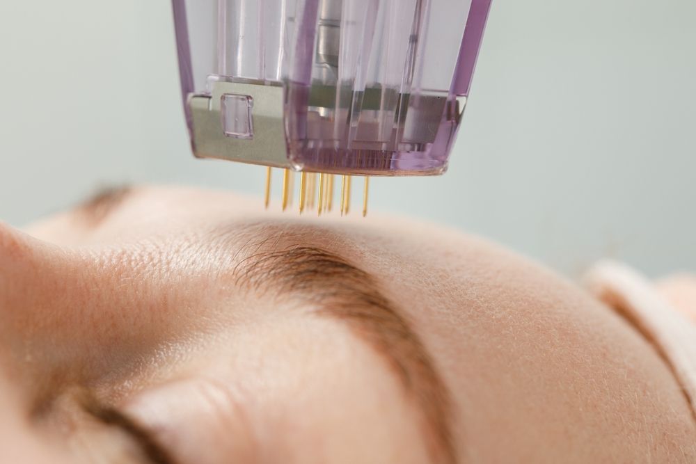 A Person's Forehead With a Microneedling Device Positioned Above — Sage Spa & Beauty in Mackay, QLD