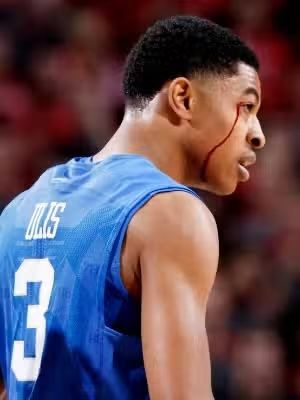 Basketball player in blue jersey with a bleeding facial wound, focused and on the court.