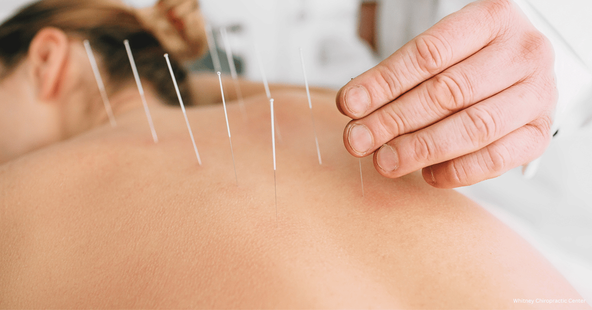 A woman is getting acupuncture on her back by a doctor.