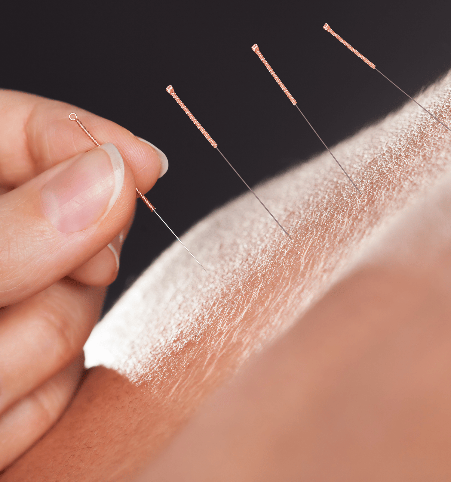A person is getting acupuncture on their arm