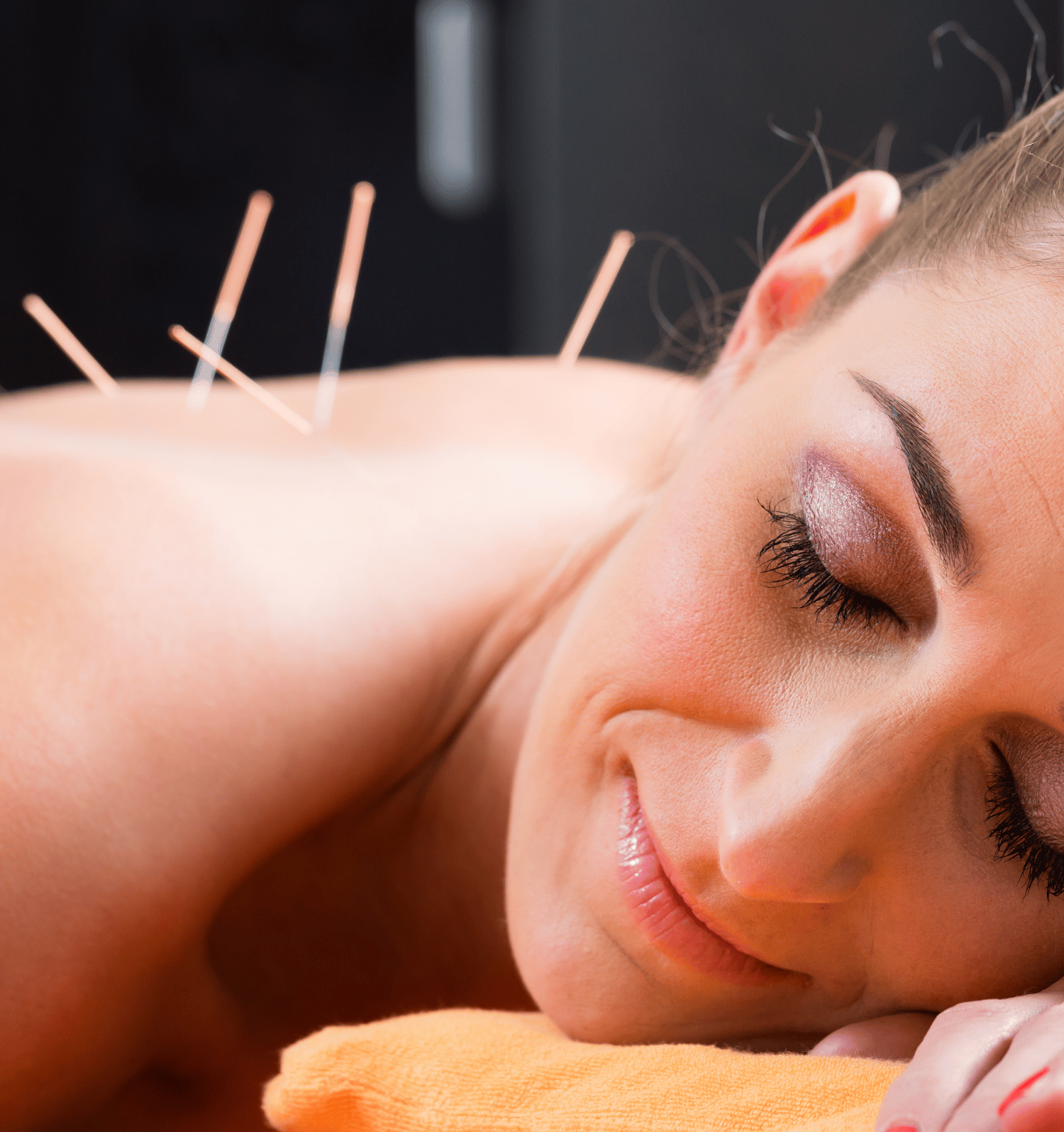 A woman is laying down with acupuncture needles in her back