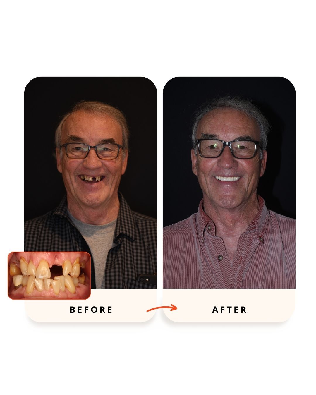 Before and after full-arch dental implant rehabilitation from Santa Barbara Dental Implants.