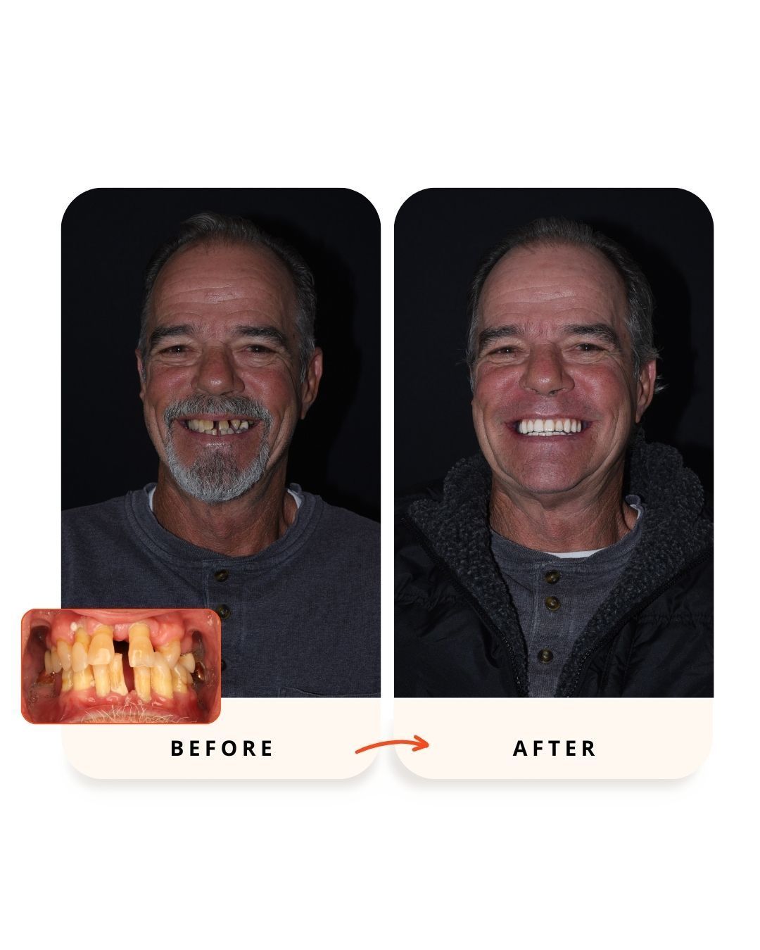 Before and after implant-supported dental restoration.