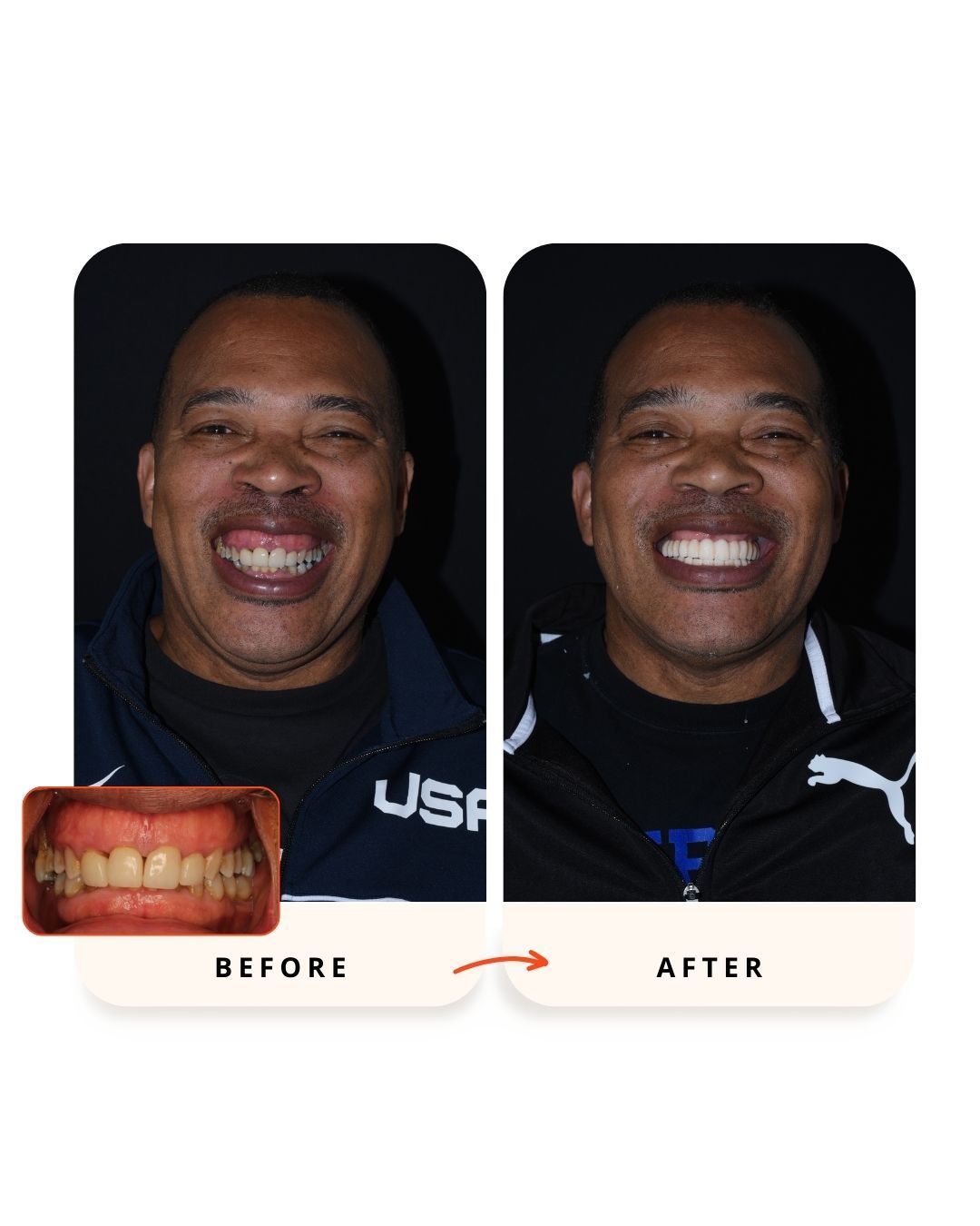 Before and after full-arch dental implant restoration.