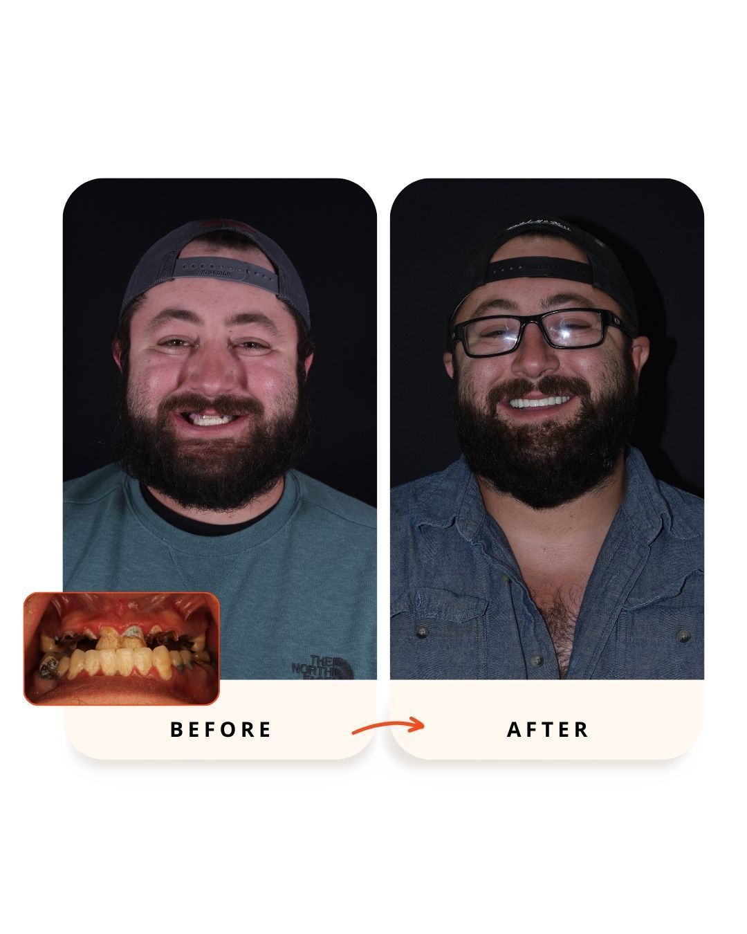 Before and after full-arch implant rehabilitation showing restored smile.