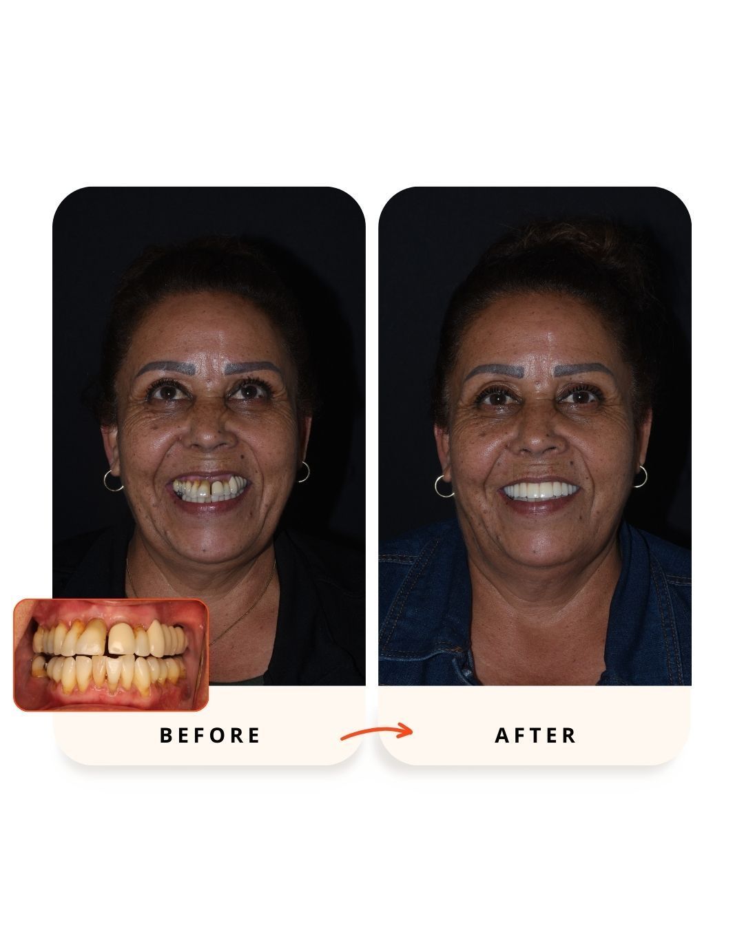 Before and after full-arch dental implant rehabilitation.