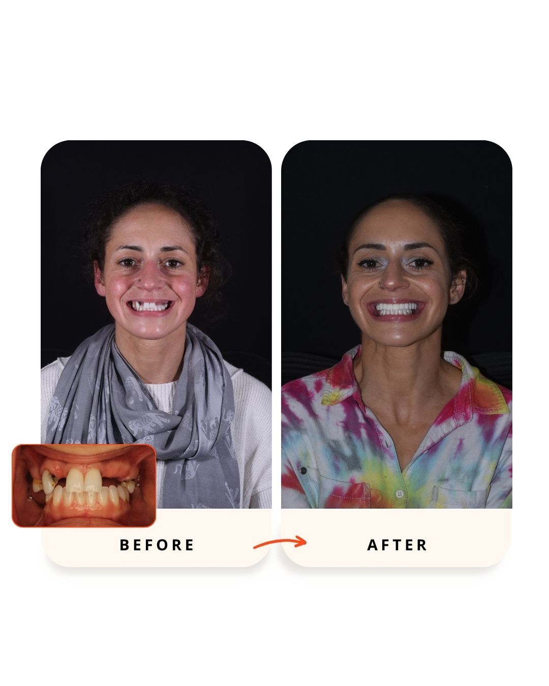 Full-arch dental implant rehabilitation before and after treatment.