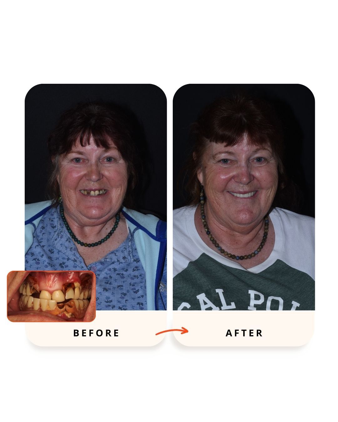 Dental implant treatment results before and after care.