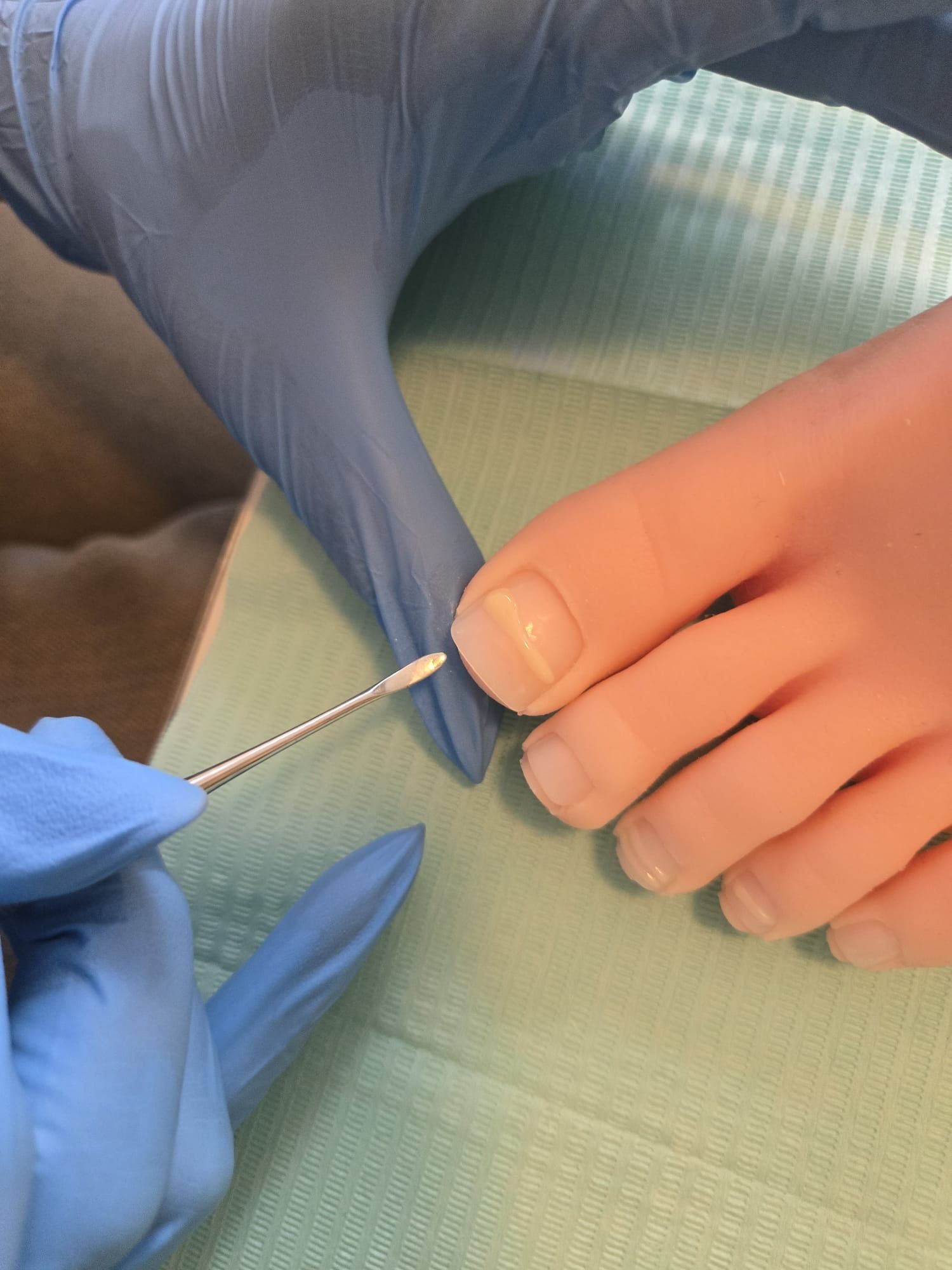 Teen met een Goldtstadt nagelbeugel 