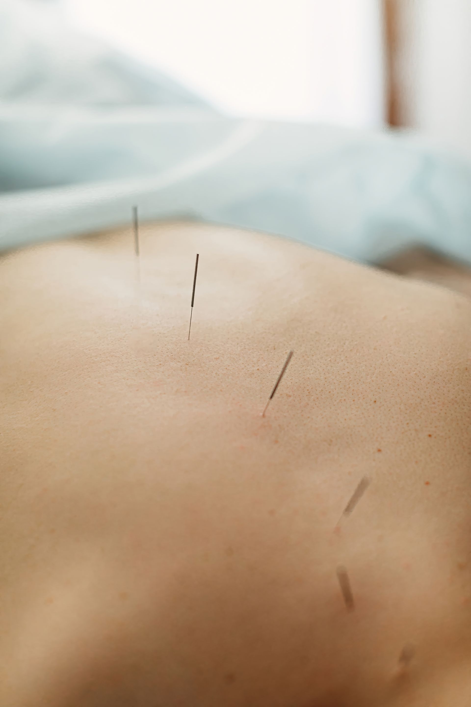 woman getting acupuncture