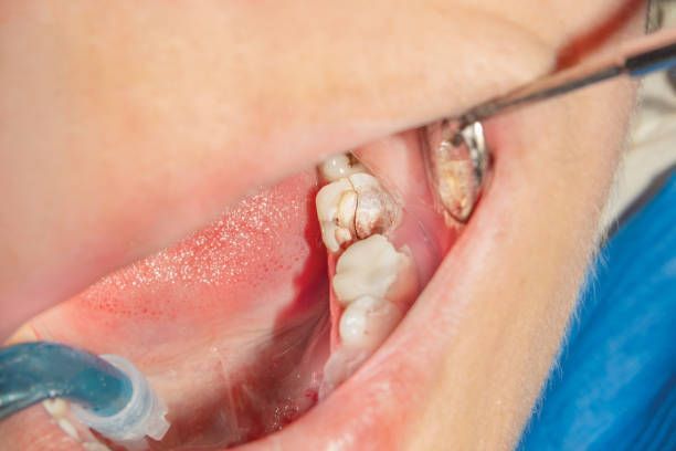 A person is getting their teeth examined by a dentist.