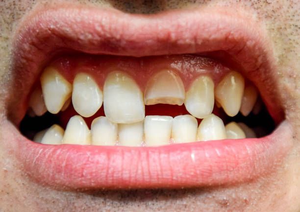 A close up of a man 's mouth with a broken tooth.