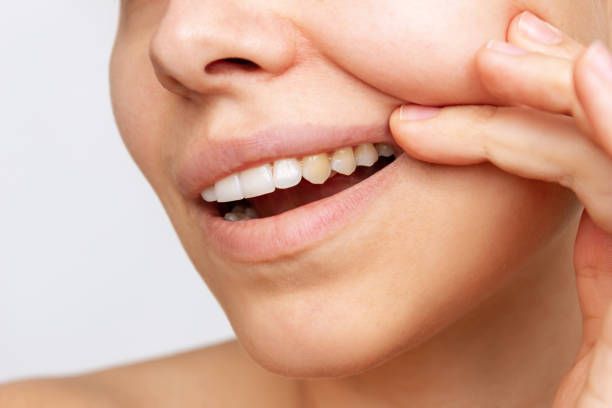A close-up of a woman's face with discolored teeth.