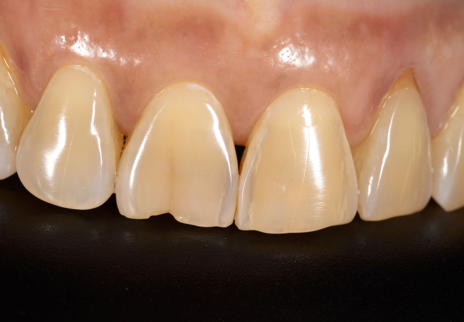 A close up of a person 's teeth on a black background.