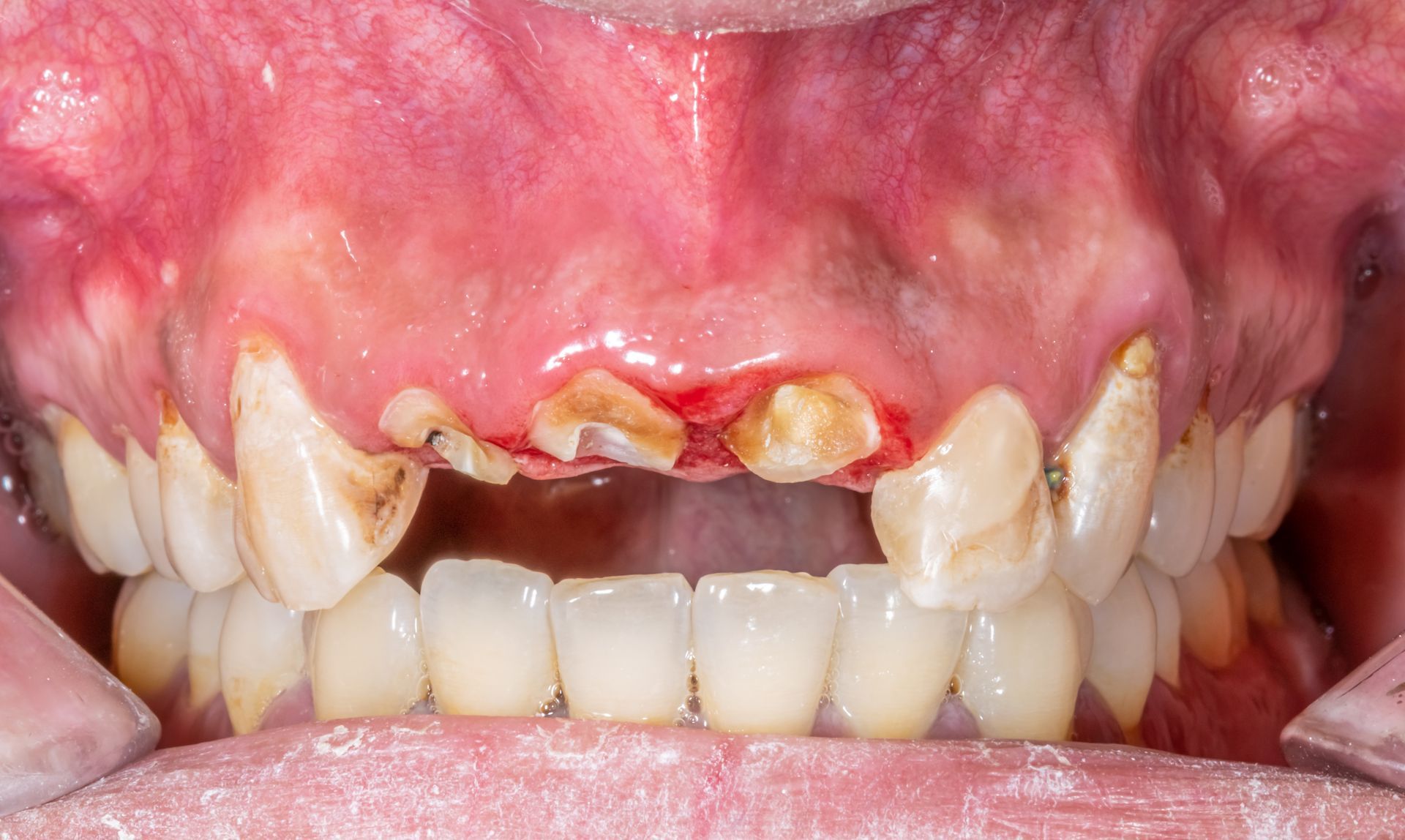 A close up of a person 's mouth with a broken tooth.