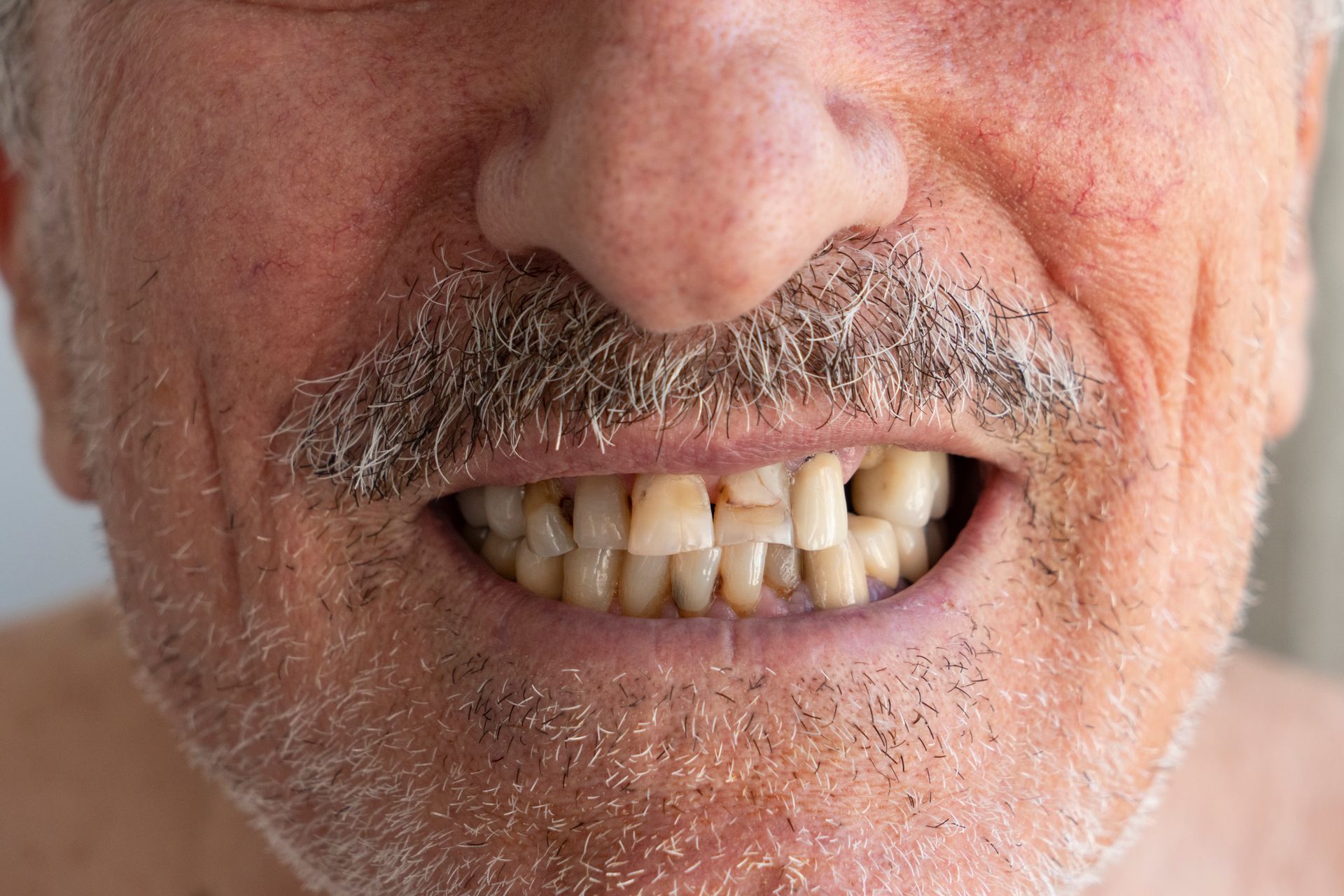 A close up of a man 's mouth with a beard and missing teeth.