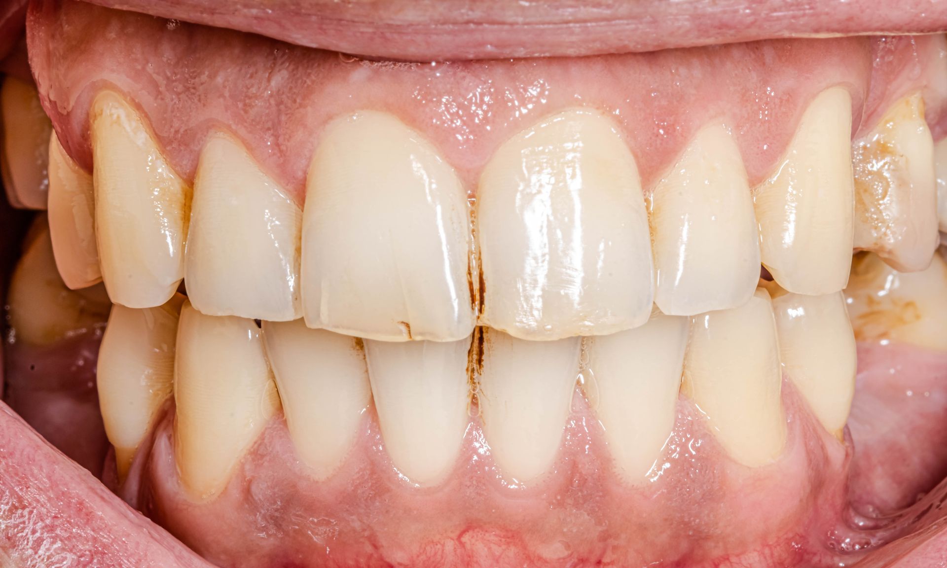 A close up of a person 's teeth with a broken tooth.