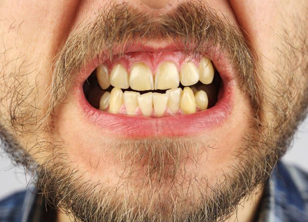 A close up of a man 's mouth with a beard showing his uneven teeth.