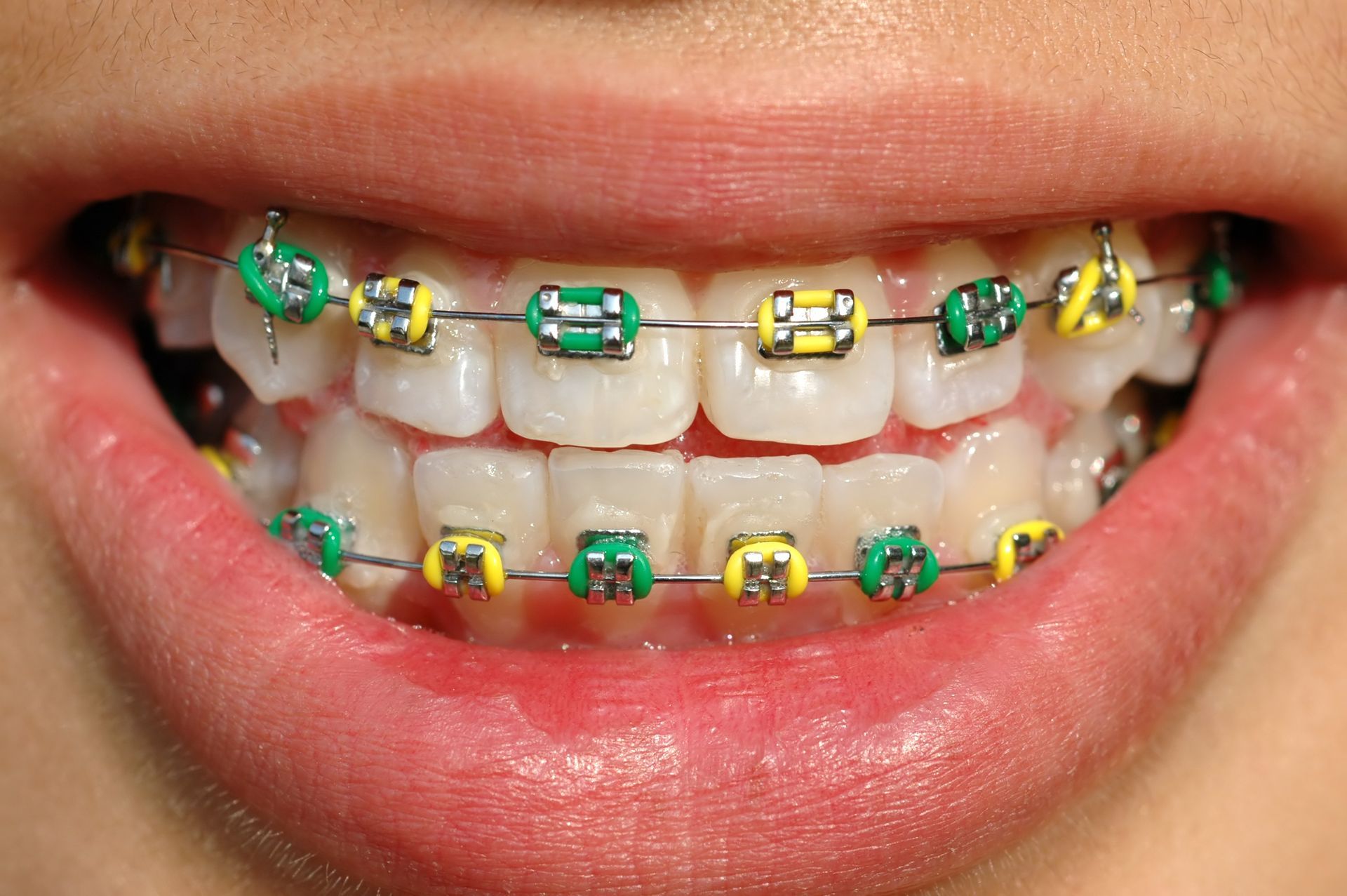 A close up of a person 's teeth with green and yellow braces