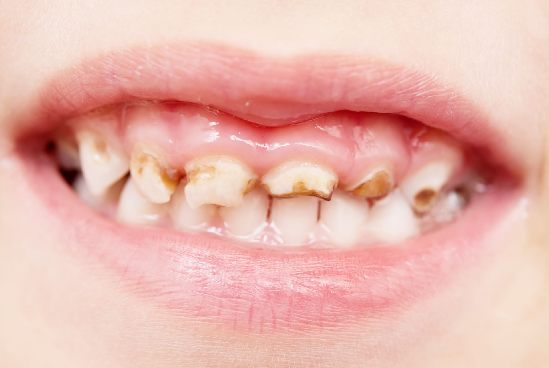 A close up of a child 's teeth with a lot of stains on them.