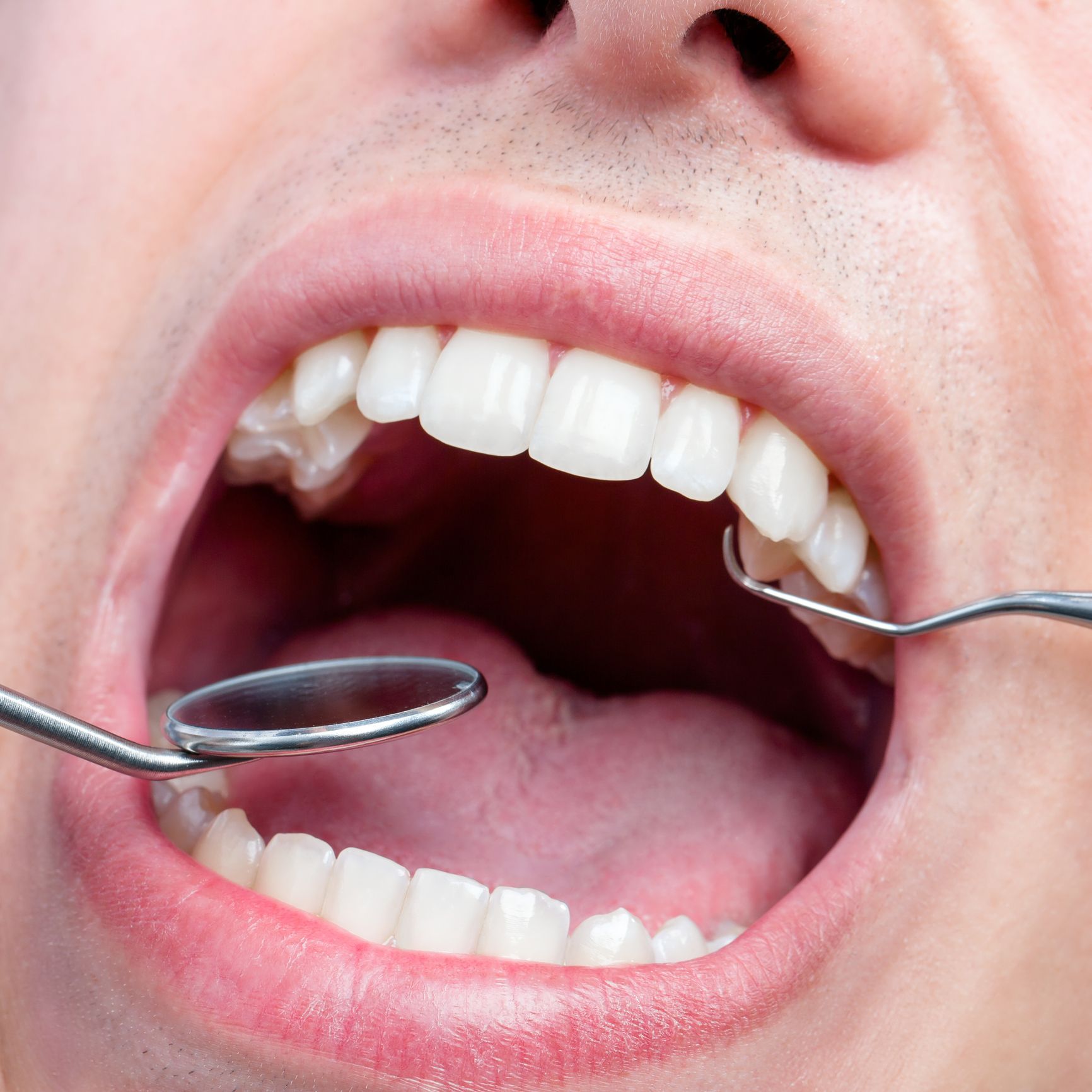 A man is getting his teeth examined by a dentist
