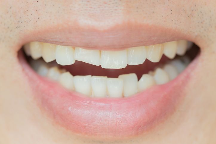 A close up of a man 's mouth with a broken tooth.