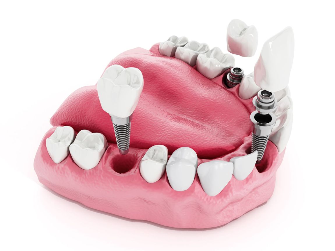 Protesica dentale