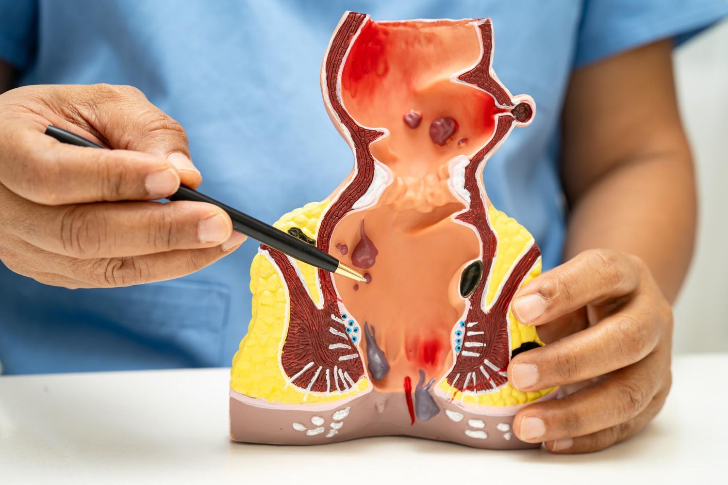 Person pointing to a model of a rectum, highlighting areas affected by hemorrhoids.