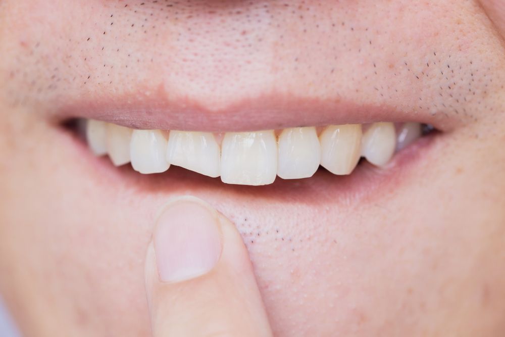 A Close Up Of A Man 's Mouth With A Broken Tooth — Cairns Precision Dental Group In Woree, QLD