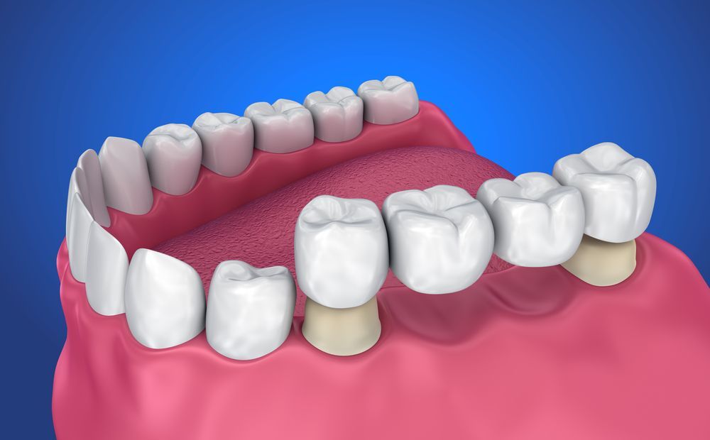 A Computer Generated Image Of A Person 's Teeth And Gums — Cairns Precision Dental Group In Woree, QLD