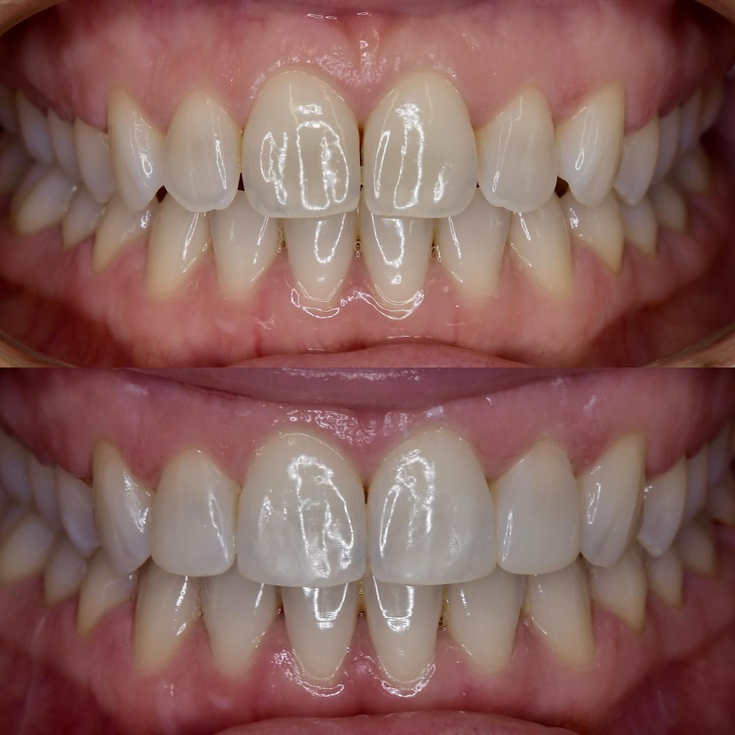 Two Sets Of Teeth, Upper And Lower Rows, Showing Slight Changes