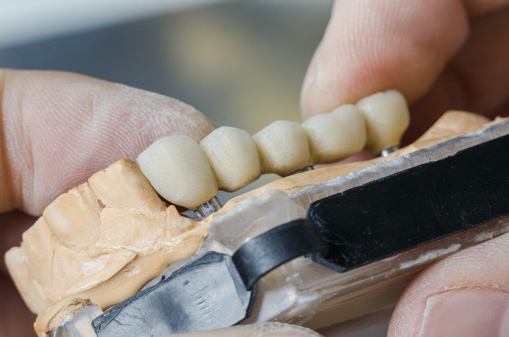 A Person is Holding a Model of a Dental Bridge — Cairns Precision Dental Group In Woree, QLD