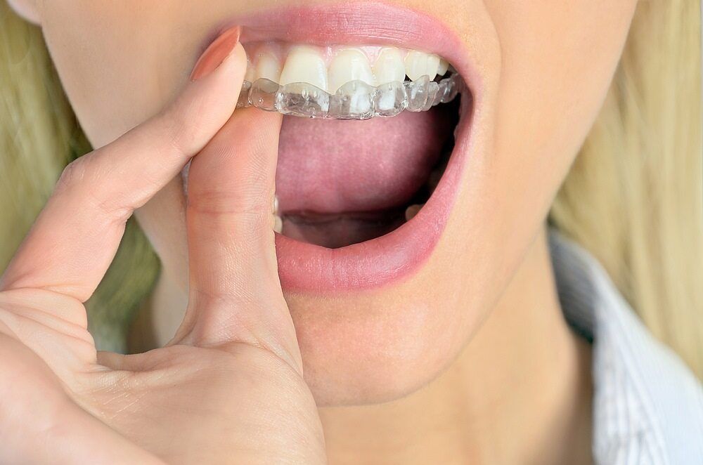 A Close Up of a Woman's Mouth With Braces on Her Teeth — Cairns Precision Dental Group In Woree, QLD