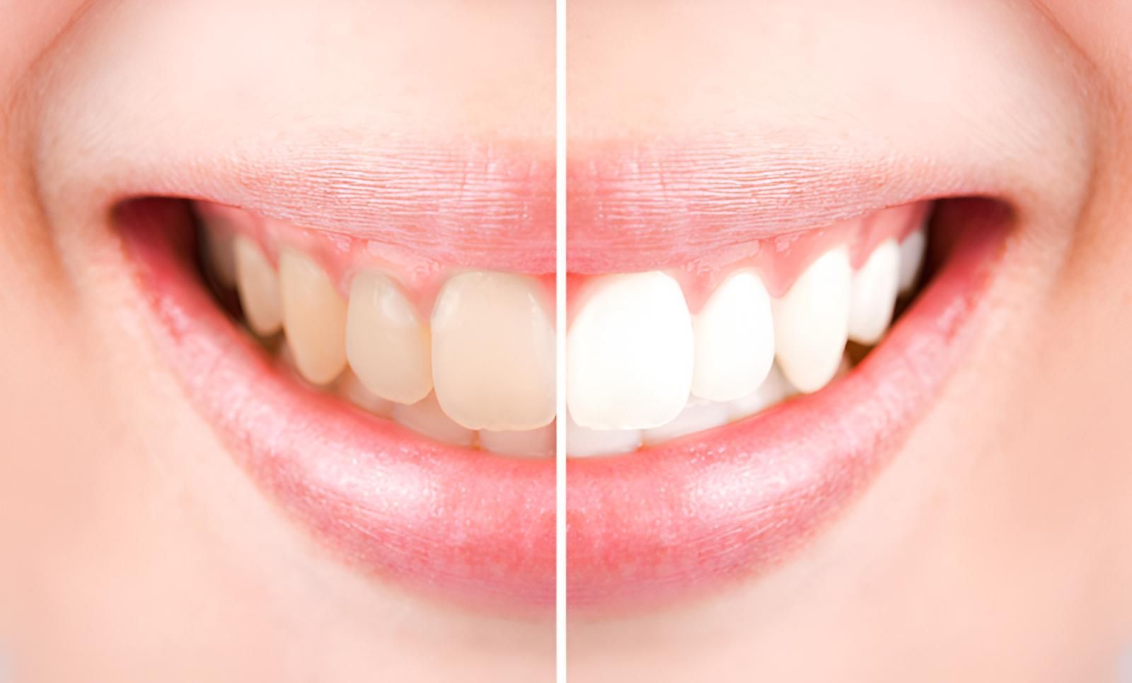 Teeth Comparison