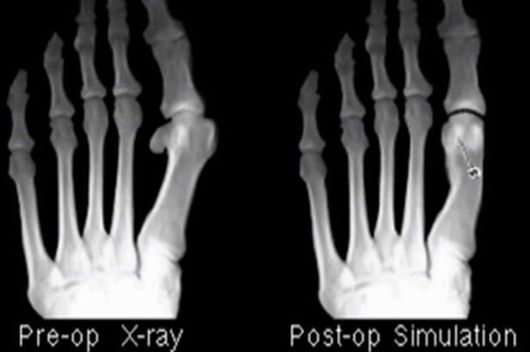 x-ray of a foot