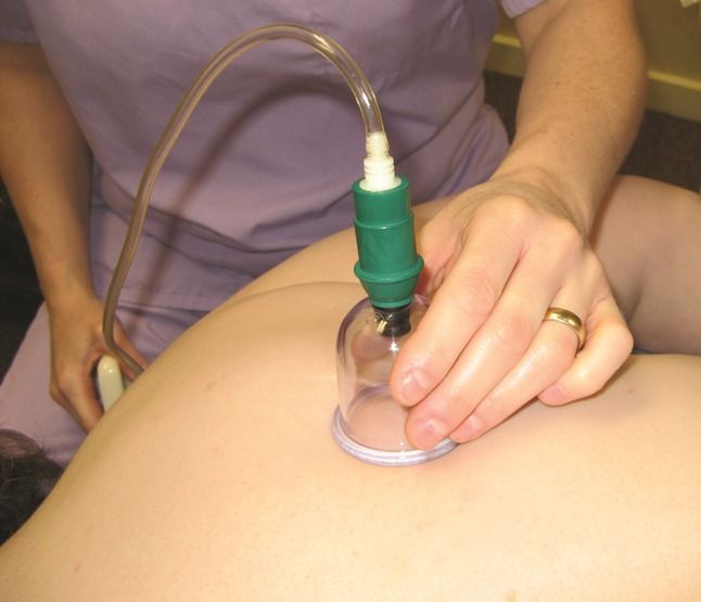 A practitioner uses a vacuum suction cup on a person's back during a cupping therapy session.