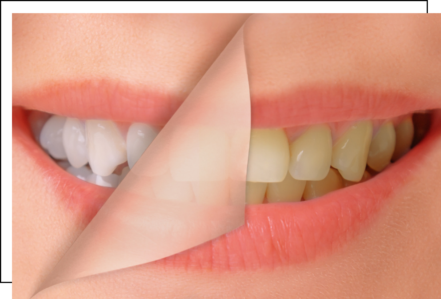 A close up of a person 's teeth before and after whitening.